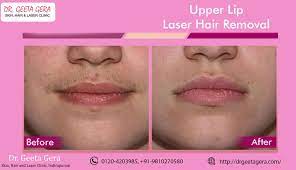 This price varies based on several factors, such as the growth of hair, size of the area to be treated, coarseness, etc. Laser Hair Removal Upper Lip Off 58 Online Shopping Site For Fashion Lifestyle