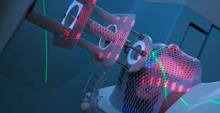 Image result for Intensity-Modulated Radiation Therapy