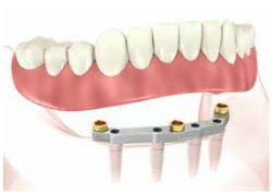 The actual cost of your implant supported denture can cover a wide range based on some contributing factors. Implant Retained Dentures Brisbane What Are The Benefits
