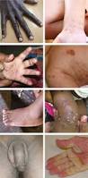 Image result for scabies in the groin area