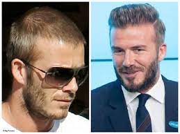 Imagehosty Push Up Interests From Web Best Hair Transplant Beckham Hair Hair Transplant