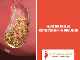 Image result for Gallstone