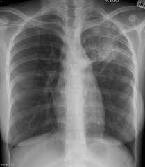 Ptb files are used to protect a user's financial data in. Tuberculosis Left Upper Lobe Radiology Case Radiopaedia Org