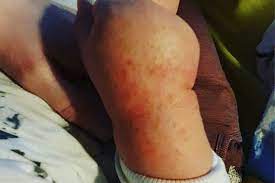 Image captionastra zeneca is the main vaccine offered in australia but increasingly people don't want it. Covid 19 Bury St Edmunds Nurse S Rash Warning Bbc News