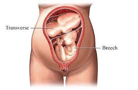 Will My Breech Baby A Flip In Time Twiniversity