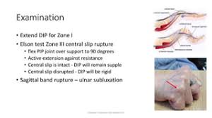 Image result for Elson Extensor Tendon Test