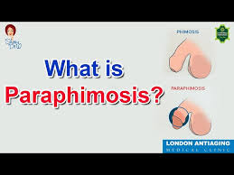 Image result for Paraphimosis