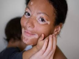 Skin Diseases: Vitiligo And Leukoderma | treatment | Homeopathic | Best Homeopathic Doctor in Pakistan | Dr Qaisar Ahmed MD, DHMS