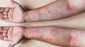 Image result for Contact Dermatitis
