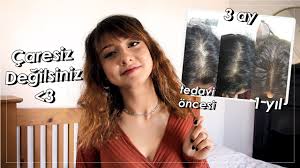 Sac Dokulmesi Ve Tedavi Surecim Mezoterapi Prp Tedavisi Minoxil Hakkinda Her Sey Youtube