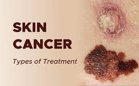 Of course, your specialist is the main person whose advice you should follow but it doesn't do anyone harm. Treatment Of Skin Cancer Non Melanoma Surgmedia