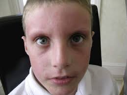 Case studies of children and adults with atopic eczema being treated under  the Aron regime