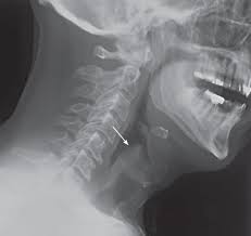 Image result for Epiglottitis