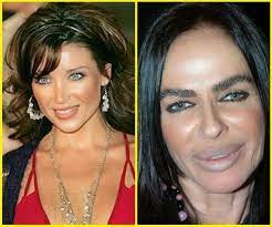 Size acceptance, body positivity, and fat activism are now part of the cultural lexicon, yet according to data f. Plastic Surgery Gone Wrong 31 Worst Celebrity Before And After