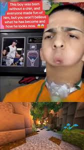 From Chinless Boy to Inspiration: Jason's Incredible Transformation