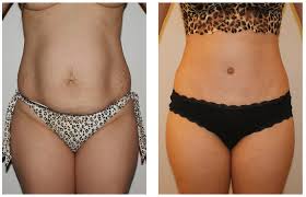 Knowing the factors for the total cost of liposuction. Do I Need A Tummy Tuck Or Liposuction Dino Elyassnia Md