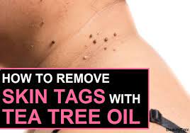How To Remove Skin Tags With Tea Tree Oil Skin Tag Removal Tea Tree Oil Oils For Skin