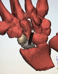 This flap can provide a versatile source of vascularized bone with limited donor site morbidity and requires minimal time for flap harvest. 3d Printing For Scaphoid Reconstruction With Medial Femoral Condyle Flap Injury