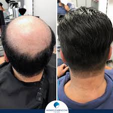 4 pezzi accessori capelli sposa,coroncina comunione bambina,accessori prima comunione,fermagli a pettine per fermaglio punti luce capelli da sposa,perle fiore . Protesi Capelli Come Scegliere L Impianto Giusto Per Te Mondo Parrucche