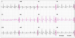 Robocop / istock what happens during a pulmonary embolism. Pulmonary Embolism Pe Pulmonary Disorders Msd Manual Professional Edition