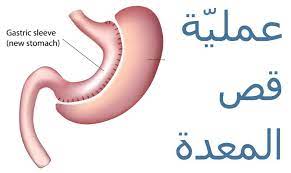 عملية قص المعدة في تايلاند 2021 تكميم أو تركيب بالون للمعدة gastric sleeve gastric band thai travel