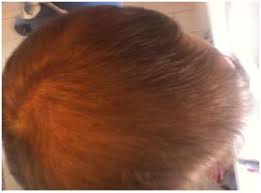 Ecklonia cava is used for cancer, arthritis, stress, obesity, heart disease, high cholesterol. My Progress So Far Pictures Hairlosstalk Forums