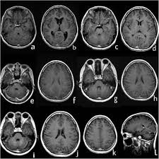 .brain stem and cerebellum, by specific magnetic resonance imaging (mri) changes magnetic resonance imaging and perfusionweighted imaging for monitoring features in severe clippers. Frontiers A Case Report Of Autoimmune Glial Fibrillary Acidic Protein Astrocytopathy Diagnosed After Long Term Diagnosis Of Chronic Lymphocytic Inflammation With Pontine Perivascular Enhancement Responsive To Steroids Neurology