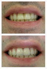 Full Ceramic Crowns On Two First Incizors And Right Second Incizor Dentist Ceramics Crown