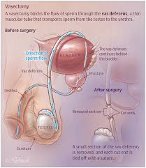 Image result for Vasectomy