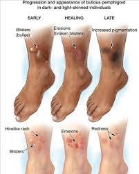 Image result for Pemphigoid