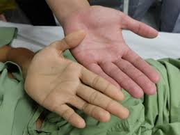 पीलिया कैसे होता है? जानें क्या हैं इसके लक्षण, कारण और उपचार | What is  Jaundice: Symptoms, causes and its treatment
