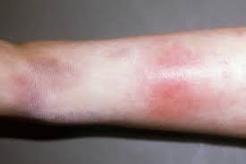 Image result for erythema nodosum