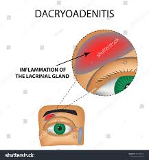 Image result for Dacryoadenitis