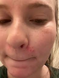 What could be causing the skin issue around my nose?