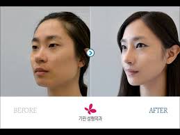 Pin By Katie Jean On Jaw Reduction Surgery Jaw Reduction Surgery Reduction Surgery Incoming Call Screenshot