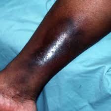 Image result for liver spots on legs