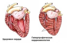 Gipertroftcheskaya Kardiomiopatiya U Koshek Simptomy Lechenie V Tom Chisle U Britanskih Koshek Skolko Zhivut