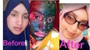 Nagalasoxirir whatsappka wa.me/+252685398987 makacabaneysaa ? finanka  wajiga haraha wajiga gududka wajiga salida wajiga iyo dhaman ciladaha ku  yimaada maqaarkiyo feyska Waxan ku heynaa dawo ad iyo ad ugu fcn waxa an kor