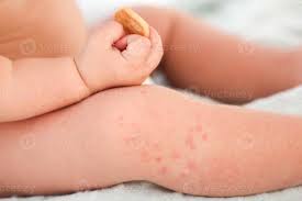 Image result for allergy rash on the legs