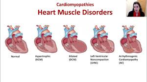 Image result for Cardiomyopathy