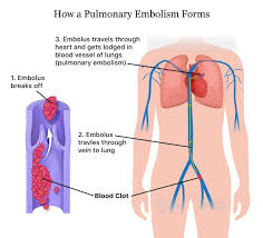 Pulmonary Embolism Pe Causes Of A Blood Clot In The Lung