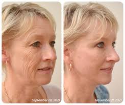 flysmus™ BotoxLUX Anti Aging Serum