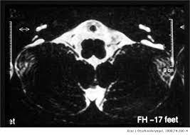Cochlear Implant And Large Vestibular Aqueduct Syndrome In Children Brazilian Journal Of Otorhinolaryngology