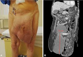 Image result for Inguinal hernia man