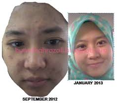 Rahsia Hilangkan Parut Chicken Pox Yang Semakin Hitam Be Youth Iful By Najihah Razali
