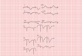 Veranderungen Des Qt Intervalls Ecg