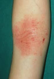 Image result for Atopic eczema atopic dermatitis