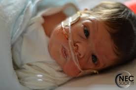 Image result for Necrotizing Enterocolitis