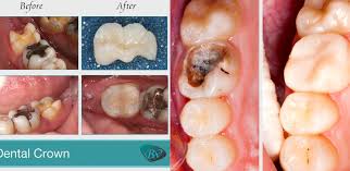 One of the main factors of how long it takes to complete a root canal is how infected. Root Canal And Crown Cost In Los Angeles Price Of Root Canal Crown