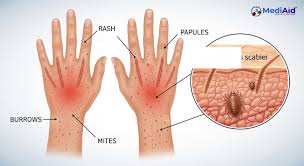 Image result for scabies human symptoms